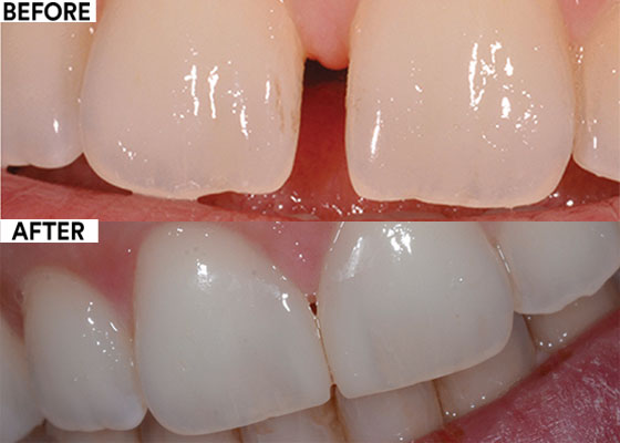 Clinical Case: Midline Diastema Closure | Solventum